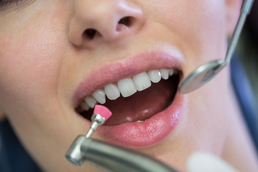 Bright Smiles: Is Teeth Whitening Truly Safe for Your Enamel?